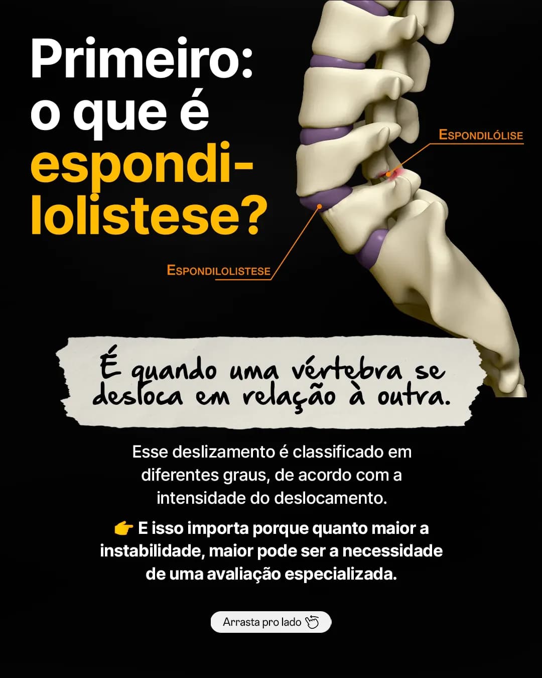 Espondilolistese: terapia manual resolve?, peça 3 de 6, feita pela Venera Digital para Anatomia Fácil
